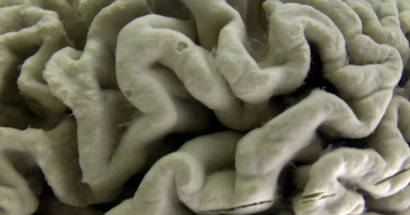 Study: Gene May Cause Alzheimer’s in Some Cases