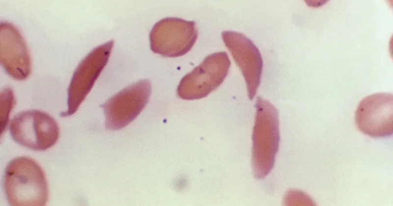 US Approves Two Treatments for Sickle Cell Disease