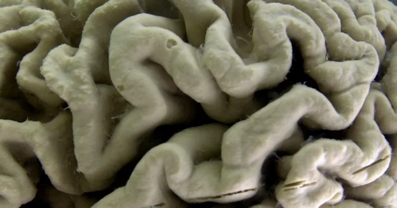 Large Study Details Years of Brain Changes in Alzheimer’s Patients