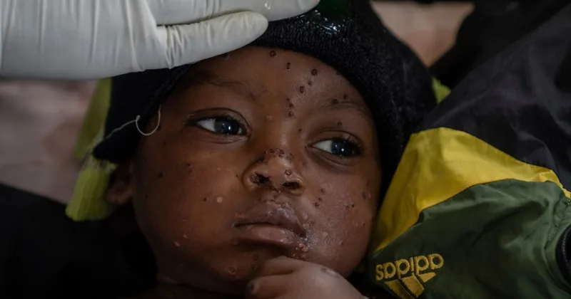 Mpox Cases in DRC Might Be Decreasing