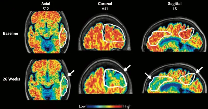 Alzheimer’s Drugs May Reach Brain Faster with Ultrasound Tool