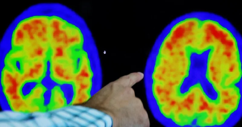 Researchers Return to Alzheimer's Vaccines