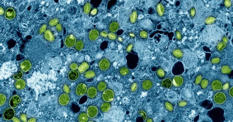 Britain Reports Four New Mpox Cases