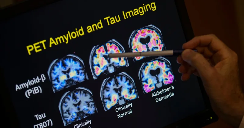 Researchers: New Blood Tests Help Doctors Identify Alzheimer’s Disease