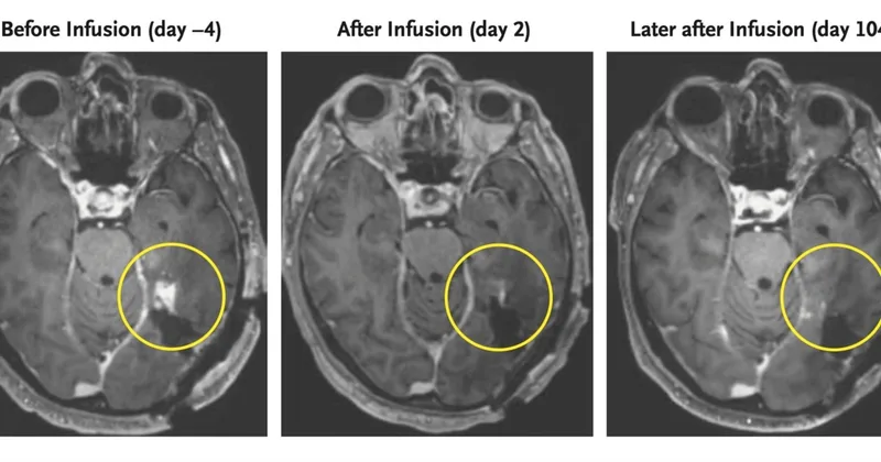 New Way to Fight Brain Cancer Shows Promise